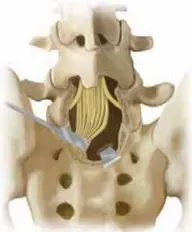 كم تكلف عملية العمود الفقري في اليمن؟ دليل الأسعار 2026