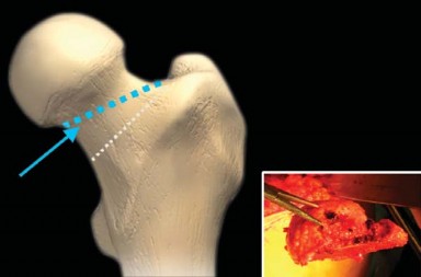 Illustration 4 for The Proxima: Why This Proximally Loading Implant Preserves Bone