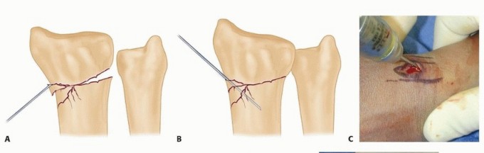 Illustration 11 for Effective K-Wire Fixation: Distal Radius Fractures Without External Fixation