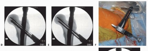 Illustration 30 for Achieve Optimal Femoral Head Fixation with Cephalomedullary Nailing