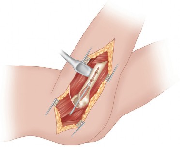 Illustration 5 for Mastering Direct Lateral Exposure for Revision Total Hip Success