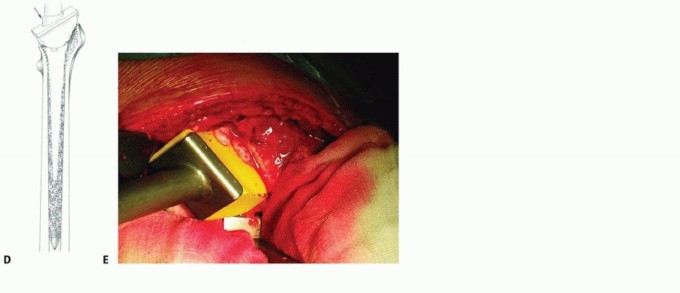 Illustration 26 for Exeter Hip Unit: Mastering Impaction Allografting for Femoral Bone Loss