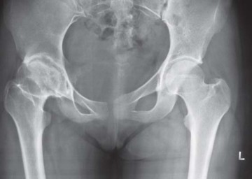 Illustration 40 for Considering METHA Short Stem? Discover Bone-Preserving THA