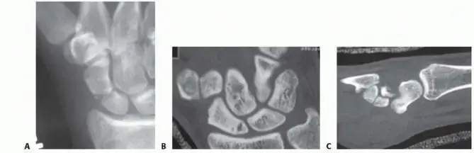 Mastering Scaphoid Fractures Open Reduction & Internal Fixation
