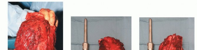 Illustration 39 for Advanced Distal Femoral Resections: Limb-Sparing Outcomes & Techniques