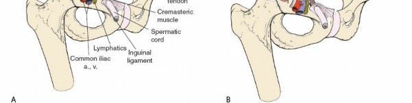 Illustration 81 for Pelvis & Acetabulum Approaches: Unlocking the Posterior Superior Iliac