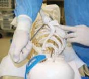 Illustration 30 for Arthroscopic Subscapularis Repair: The lo iky brady Method for Stability