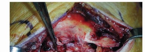 Illustration 18 for Medial Ankle Instability: Find Relief with Reconstruction