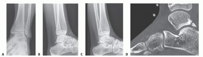 Posterior Ankle Arthroscopy & Hindfoot: Solutions for Deep Pain