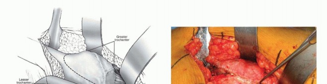 Surgical Hip Dislocation Safety: The Branch of the MFCA's Vital Role