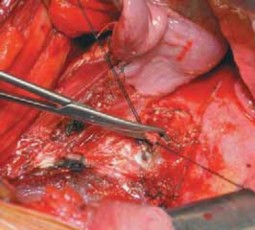 Illustration 39 for Mastering Anterior Interbody Arthrodesis with Instrumentation for Scoliosis