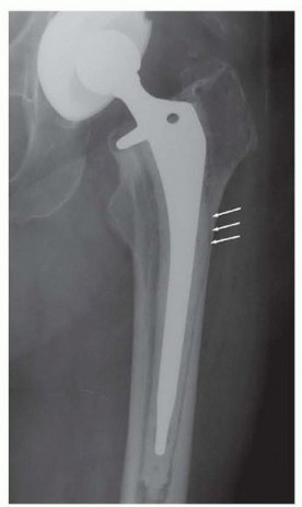 Illustration 7 for Resection Arthroplasty & Spacers: Optimizing Time of Reimplantation
