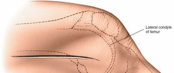Illustration 221 for Mastering Knee Approaches: Spotlight on Superficial Medial Ligament