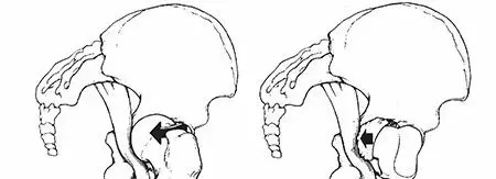 صورة توضيحية لـ خلع الورك: دليلك الشامل من الأسباب والعلاج إلى التعافي مع الأستاذ الدكتور محمد هطيف