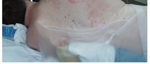 Illustration 8 for End CN XI Palsy Pain: The Eden-Lange Procedure Solution