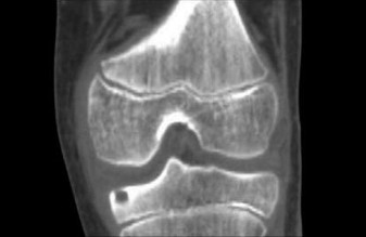 Oncology Cases Osteoid Osteoma: Spotting & Treating the Pain
