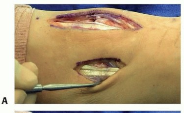 Illustration 15 for Fixation of Lisfranc Injuries: Essential Open Reduction Guide