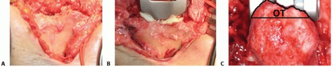 Illustration 33 for Distal Humeral Fractures: When Is Elbow Replacement the Best Option?