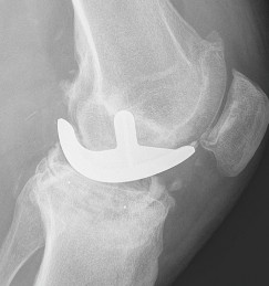 Illustration 2 for Understand Augments: The Role of Metal Augments in Arthroplasty