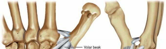 Ligament Stabilization of the Unstable Thumb Carpometacarpal Joint