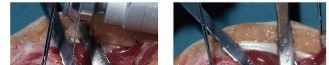 Illustration 15 for Precision Correction for Distal Radius Malunion
