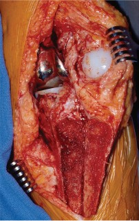 Illustration 24 for Precision Soft Tissue Balancing in Revision: Avoid TKA Pitfalls