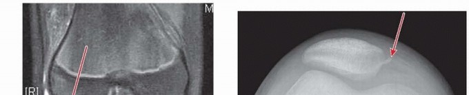 Illustration 3 for Chronic Patellar Instability: From Acute Onset to Lasting Solutions