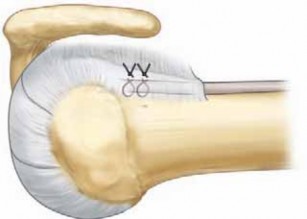 Illustration 16 for Resolve Long Head Biceps Pain: Advanced Arthroscopic Treatment