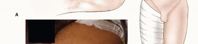 Illustration 23 for Mastering Above-Knee Amputation: Essential Surgical Insights