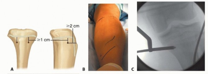 Illustration 10 for Optimal Treatment for Pediatric Tibial Fractures: Key Insights