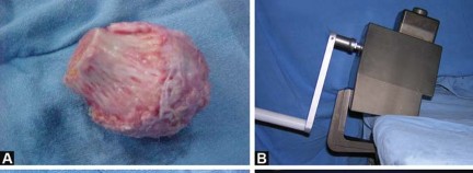 Illustration 30 for Total Hip Replacement for Protrusio: Restore Your Hip Function