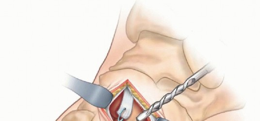 Illustration 12 for Why Anterior Tibialis Muscle Transfer Fixes Clubfoot