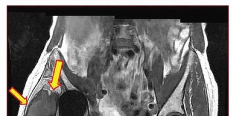 Illustration 19 for Which Bearing Surface Options Are Best for Your Total Hip?