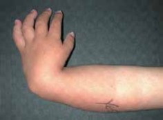 Illustration of chapter radial dysplasia - Dr. Mohammed Hutaif