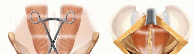 Illustration 13 for Achieve Stable Fixation of the Symphysis: Open Reduction