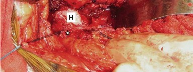 صورة توضيحية لـ إتقان توازن الأنسجة الرخوة لمفصل ورك صناعي مثالي: دليل شامل للمرضى مع الأستاذ الدكتور محمد هطيف