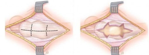 Illustration 126 for Stop the Snap: Hip Preservation for Snapping Iliopsoas Tendon