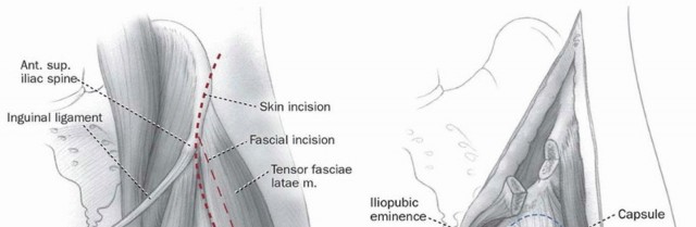 صورة توضيحية لـ جراحة قطع العظم حول الحُق وقطع عظم الفخذ: إعادة محاذاة مفصل الورك لراحة دائمة مع الأستاذ الدكتور محمد هطيف