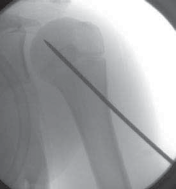 Illustration 13 for Mastering Pediatric Shoulder Fractures: Clinical Insights