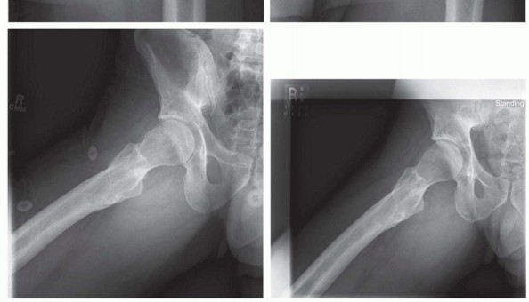 Illustration 11 for Hip Arthroscopy: Your Minimally Invasive Solution for Hip Pain