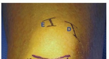 Illustration 21 for Advanced Nailing of the Mature Tibia: Overcoming Complexities