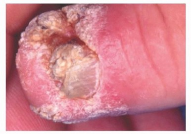 Squamous Cell Carcinoma and Melanoma of the Hand