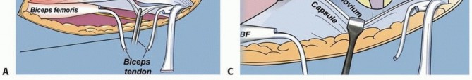 Illustration 42 for Treatment for Congenital Femoral Deficiency: What You Need to Know