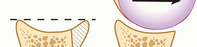 Illustration 2 for Latarjet for Instability: Bone Loss Solutions, Per Burkhart SS, Lo