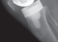 Illustration 40 for PROSTALAC Articulating Spacer: Treat Infected Knees, Regain Mobility