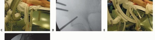 Illustration 24 for Emergency Fixation of the Pelvis: Control Bleeding & Restore Stability