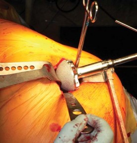 Illustration 31 for Exploring the Ambulatory Surgical Setting for Total Hip Replacement