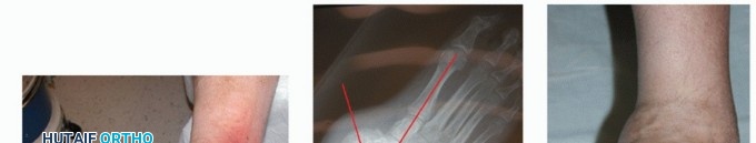 Illustration 9 for Regain Mobility: Surgical Solutions for Charcot Foot Arthropathy