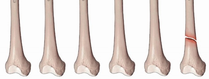 Illustration 2 for Mastering Fixation of Periprosthetic Fractures of the Femur
