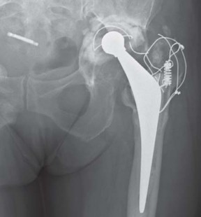 Illustration 13 for Management of Periprosthetic Fractures: An Expert Surgical Guide